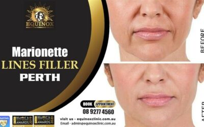 Discover Your Inner Glow with Marionette Lines Filler
