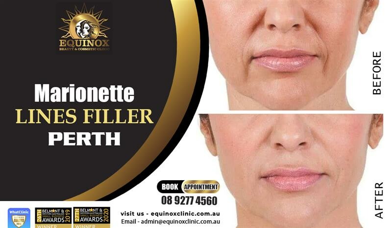Marionette Lines Filler Perth