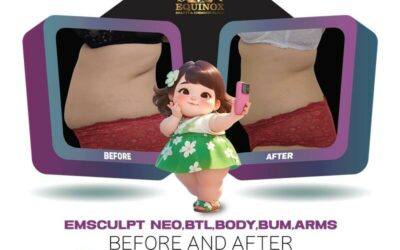 Sculpt Your Dream Body with Emsculpt Neo, BTL, Body, Bum & Arms Treatment