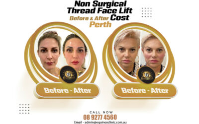 Non-Surgical Thread Face Lift Before and After | Ignite Your Inner Spark !