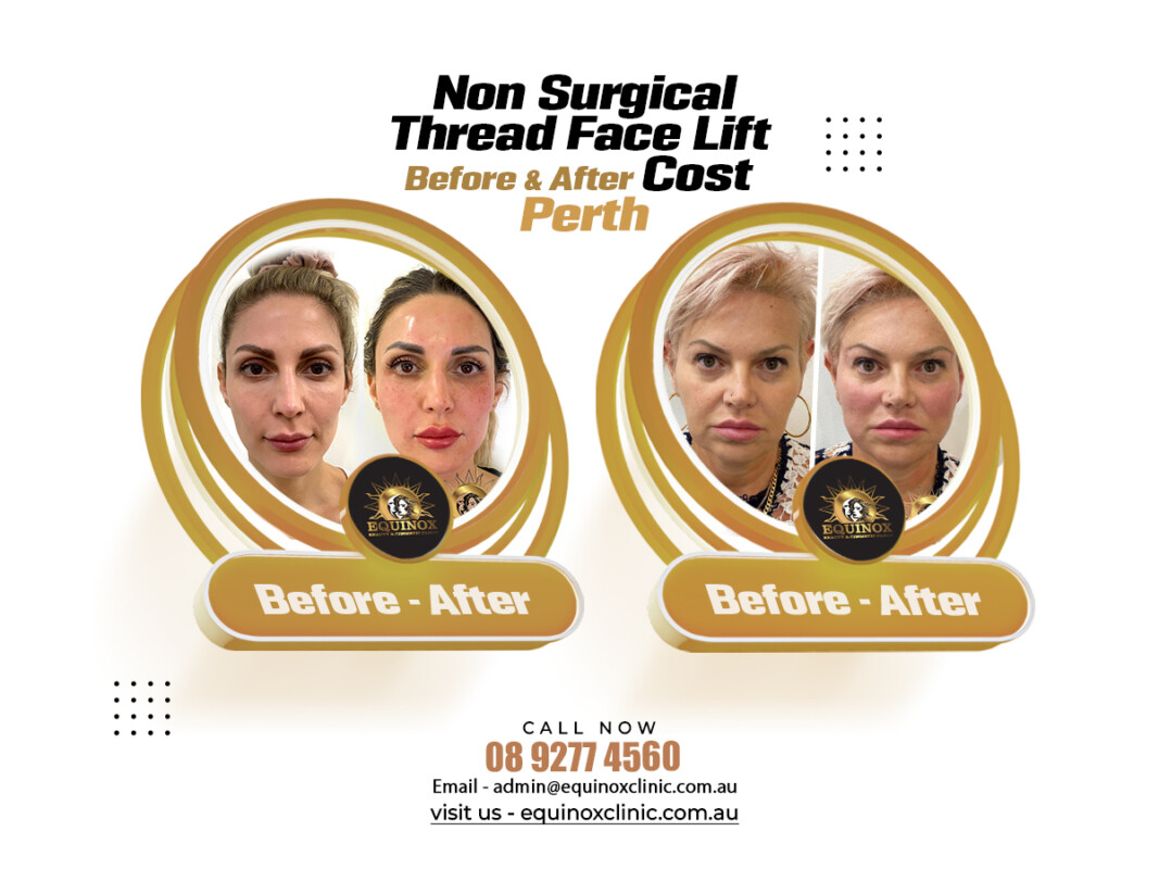 Blogs 6 Non-Surgical Thread Face Lift Before and After | Ignite Your Inner Spark !