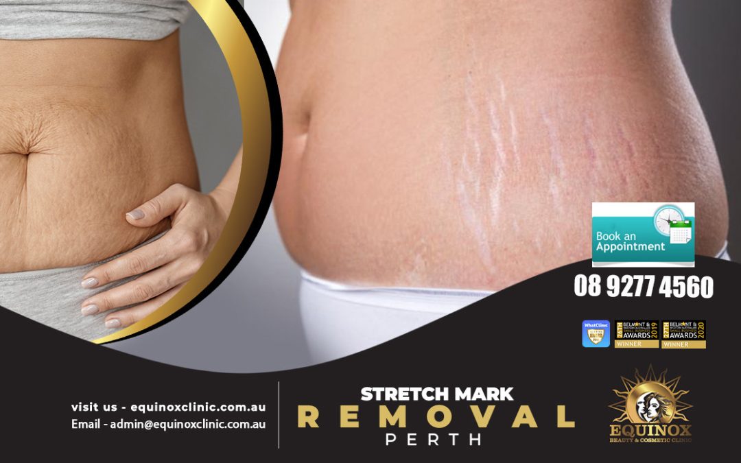 Discover The Solution To Remove Stretch Marks