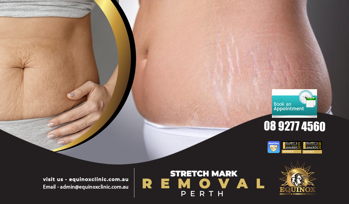 Blogs 6 Discover The Solution To Remove Stretch Marks