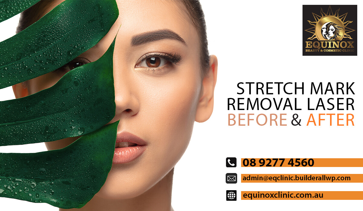 Stretch Mark Removal Perth