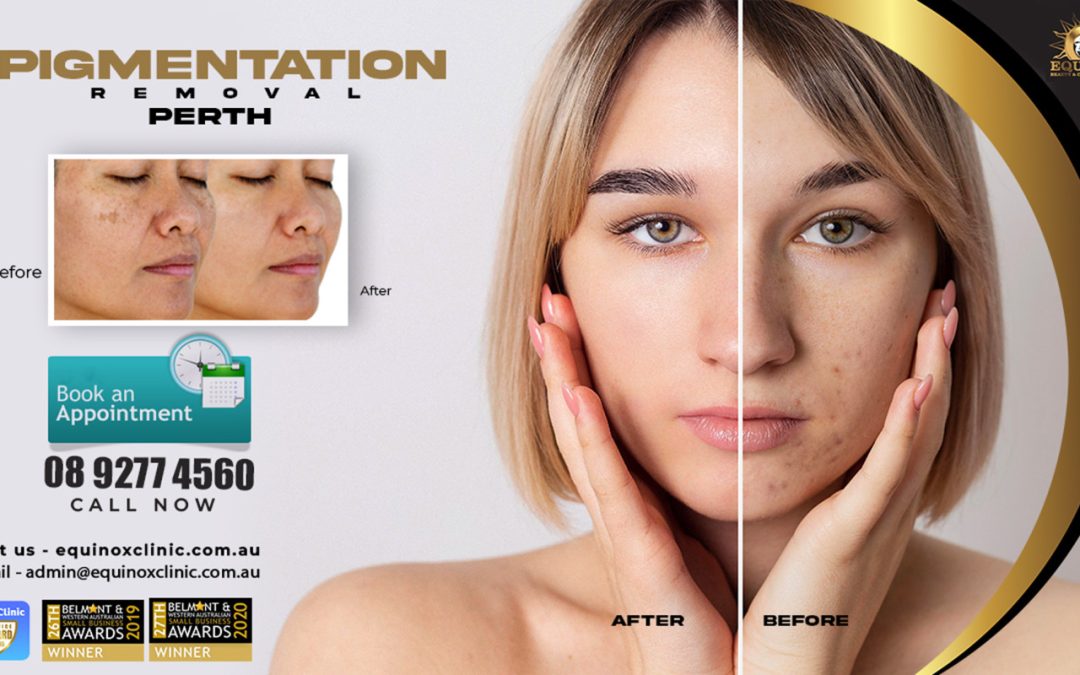 Discover The Effective Treatments For Pigmentation On The Skin
