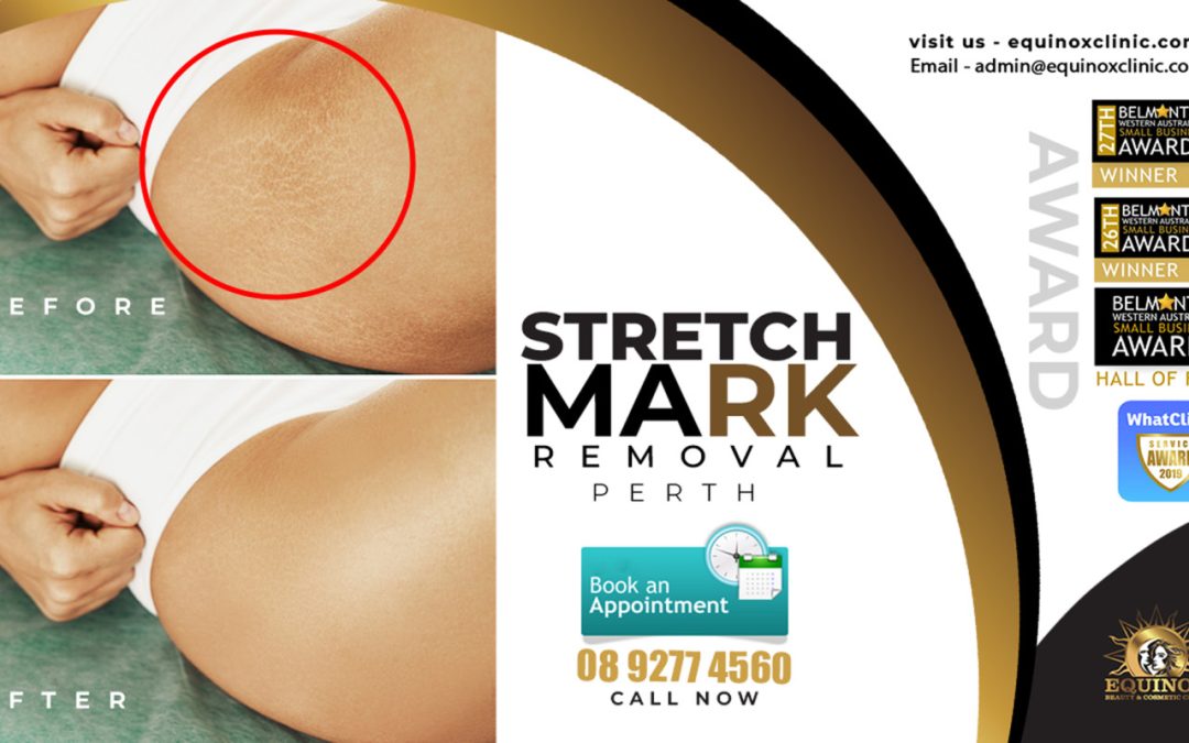 An In-depth Knowledge on Stretch Mark Removal Treatments